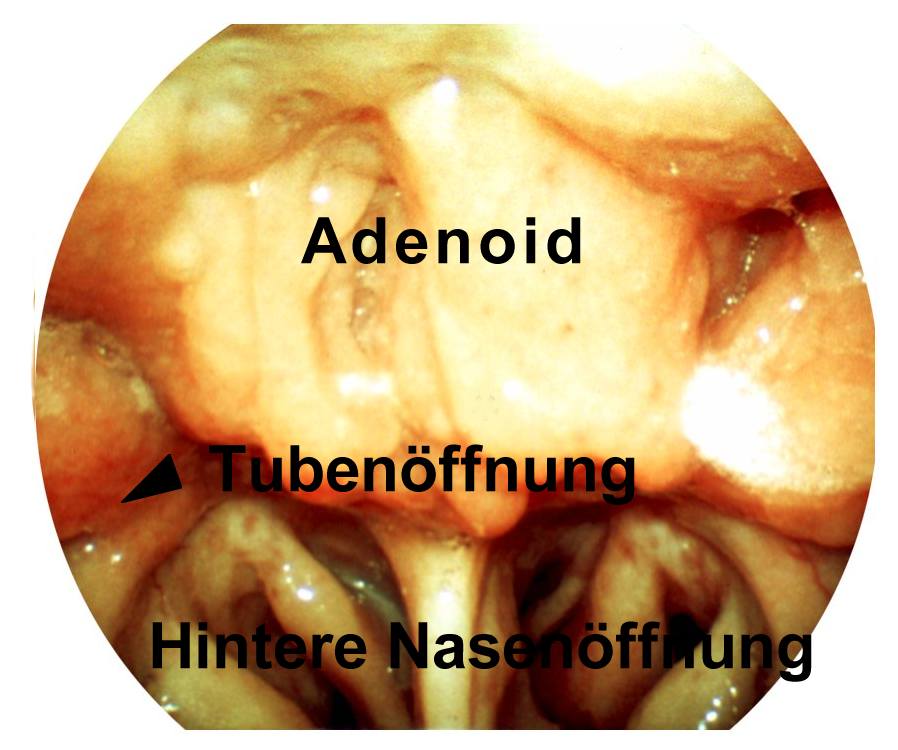Adenoidhyperplasie