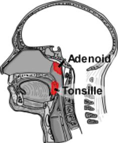 Schema Tonsillen, Adenoide